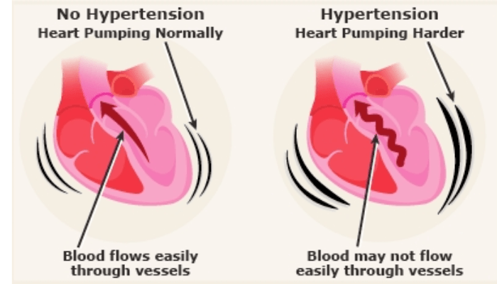 Hypertension Secret Revealed: Unravel the Mysteries!