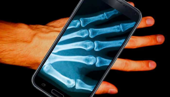X-ray app on your cell phone – free and easy to use app